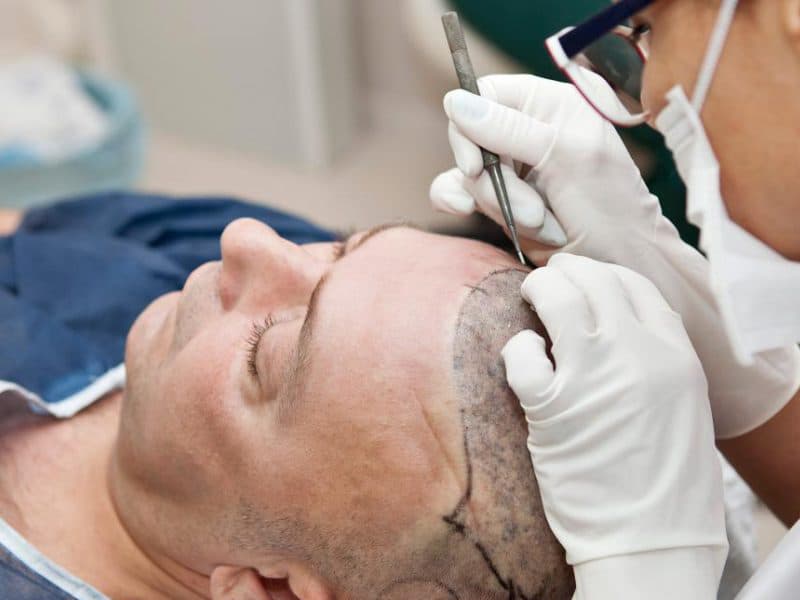Why is Turkey the most suitable place for hair transplantation?